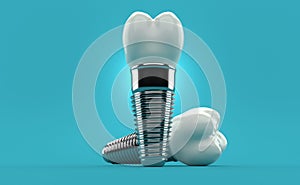 Dental implants