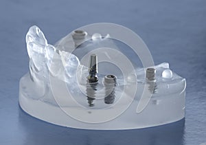 Dental implants