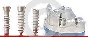 Dental implants