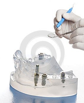 dental implants