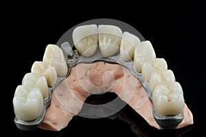 Dental implants on a black background
