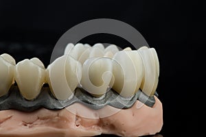 Dental implants on a black background