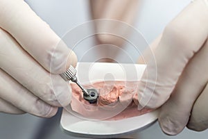 Dental implants are checked in an articulator in a dental laboratory. selective focus