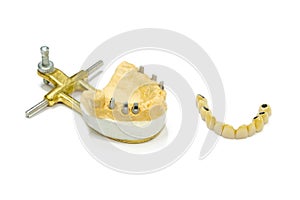 dental implants. dental ceramic crowns on implants. artificial teeth on abutments. ceramic crowns on artificial roots