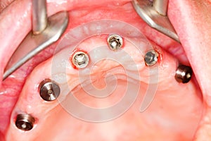 Dental implants with gingival cuffs photo
