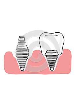 Dental implants  and gingival   illustration cartoon icon  white colors