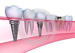 Implantes dentales en goma 