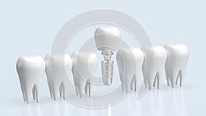 The dental implants for health and medical concept 3d rendering