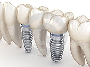 Dental Implants in line. 3D illustration concept of human teeth