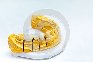 Dental implants. Restore lost teeth. Dental bridge on the jaw mockup. Dental laboratory