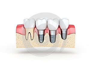 Dental implants showing bone and gum structure tooth teeth
