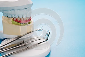 Dental implants supported overdenture.