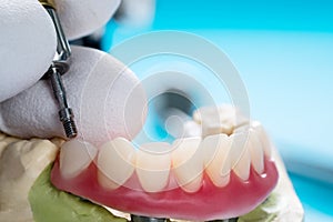 Dental implants supported overdenture.