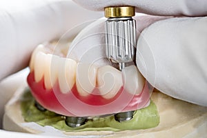 Dental implants supported overdenture.