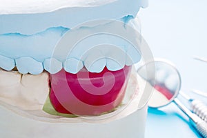 Dental implants supported overdenture.