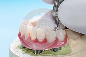 Dental implants supported overdenture.