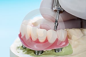 Dental implants supported overdenture. photo