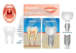 Dental implants vector illustration. Labeled medical scheme with tooth cap.