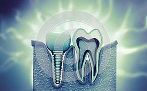 Dental implement