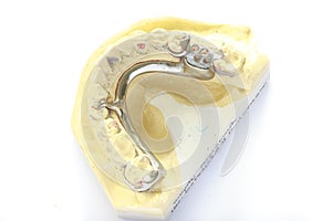 Dental impression model with laboratory metal framework