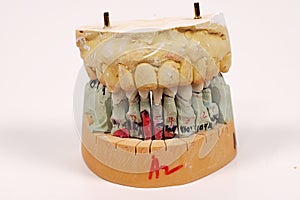 Dental Impressions