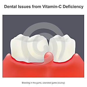 Dental Issues from Vitamin C Deficiency. Illustration