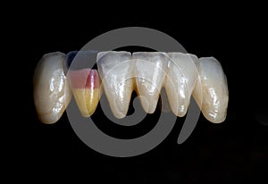 Dental laboratory work. Ceramic teeth.