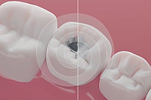 Dental mecury amalgam and composite filling