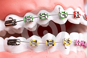 Dental metal brace teeth model