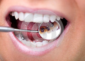 Dental mirror showing lingual braces