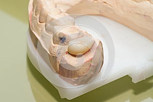 Dental model with all ceramic veneer, ceramic crown and zirconia crown