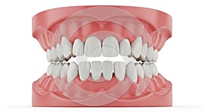 Dental model displaying teeth alignment
