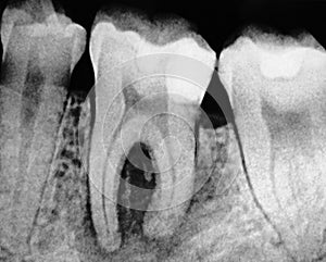 Dental Molar X-ray photo