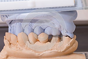 Dental Mold For Prosthetic Teeth
