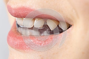 Dental mouthguard, splint in the mouth for the treatment of dysfunction of the temporomandibular joints, bruxism photo