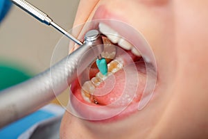 Dental obturation photo