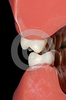 Dental occlusion molars teeth close up