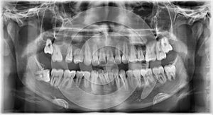 Dental panaromic x-ray film photo