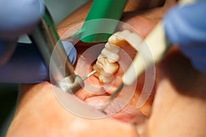 Dentale ottenere suo sedia dente cavità forato 
