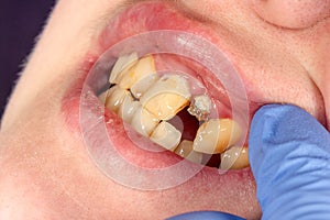 Dental pin close-up, preparation of the tooth for the formulation of the ceramic crown. The concept of prosthetics in dentistry