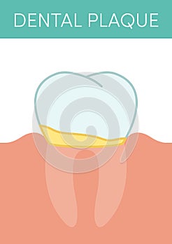 Dental plaque concept