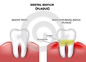 Dental plaque photo