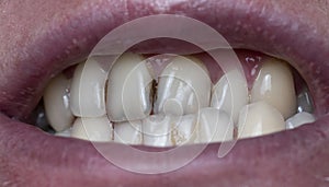 Dental plaque on man`s teeth caused by coffee residual photo