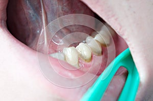 Dental plaque on teeth, caries, gingivitis, periodontitis, periodontal disease, tartar, professional oral hygiene, gingivitis photo