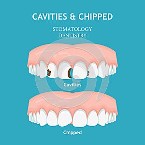 Dental poster. Dentistry and stomatology poster. Cavities and chipped