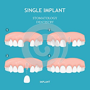 Dental poster. Dentistry and stomatology poster. Single implant.