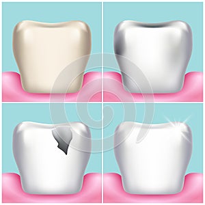 Dental problems, caries, plaque and gum disease, healthy tooth vector illustration