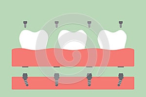 Dental prostheses, filling denture on gum