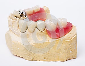 Dental prosthesis