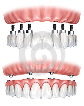 Dental prosthesis